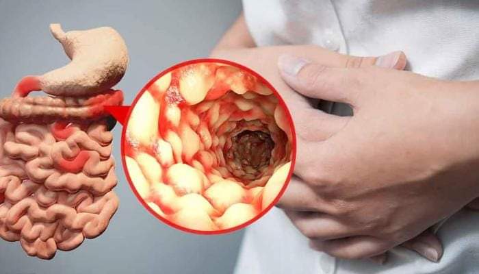 ما هو داء كرون Crohn's disease؟ و ما هي أسبابه ؟