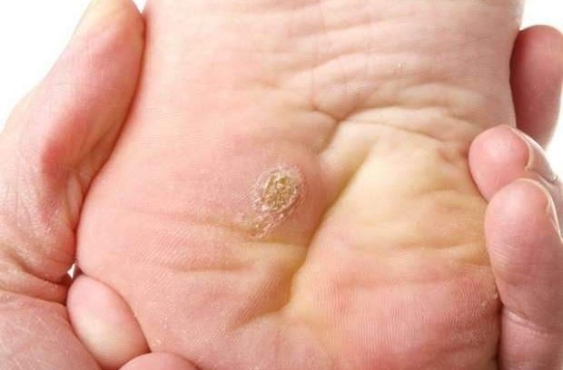 ما هي مسامير القدم؟وما أسبابها ؟و كيف يتم علاجها؟
