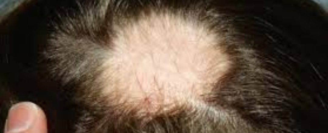 الحاصة البقعية ،أو الثعلبة Alopecia areata ماهي ومالالية المرضية؟