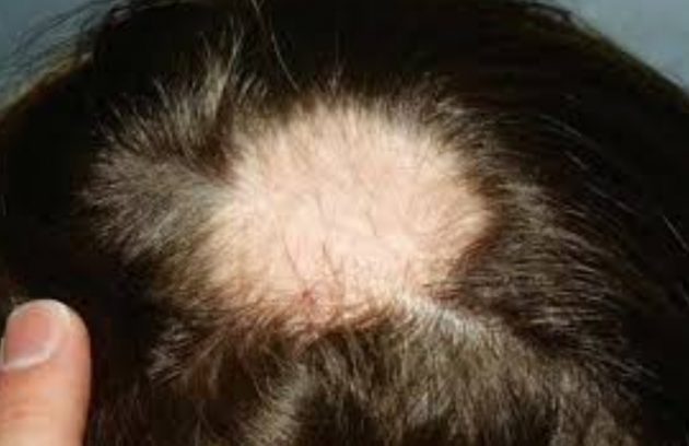 الحاصة البقعية ،أو الثعلبة Alopecia areata ماهي ومالالية المرضية؟